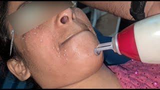 Melasma and freckles removal by laser || Dr.Arif Iqbal ( Dermatologist & Cosmetologist )