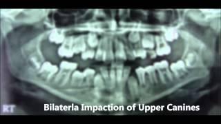 Non-Extraction Treatment of Bilateral Impaction of Upper Canines - Dina 14yrs