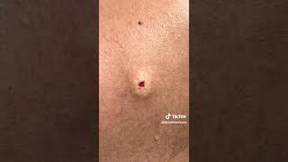 In-office mole removal with Dr. John Tedesco