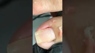 I try to cut both side of nails to clean dry skin