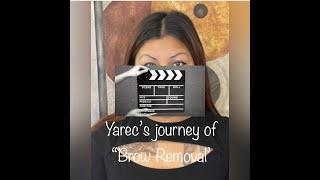 Yarec's journey with "Brow Removal" - Unfiltered