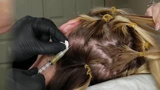 Non Surgical hair Restoration using PRP and ACELL Elite Medical Aesthetics Rocklin