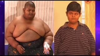 best bariatric surgery results by Dr Ravikanth kongara Hyderabad Vijayawada