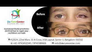 De Cure Center | Ocular Prosthetics | Artificial Eye | Oncologists