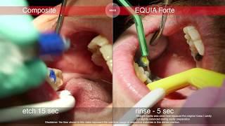 How to save chair time: using EQUIA Forte versus composite demonstrated in a clinical case