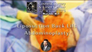 135lb weight loss after gastric bypass surgery, Liposuction, Back Lift (upper) Abdominoplasty