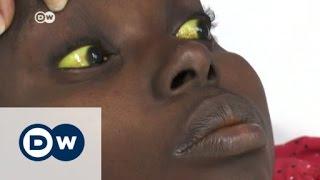 Yellow fever epidemic spreads in Angola | DW News