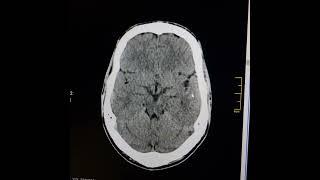 Colloid cyst of brain