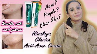 Himalaya Clarina Anti-Acne Cream Review Hindi How to get clear skin? HOW TO GET RID OF ANCE FAST