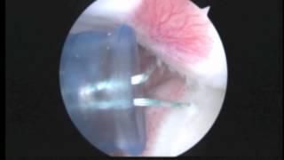 Don Buford MD, Posterior Shoulder Dislocation Surgery