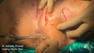 Anal Fistula In Female With 5 Tracts On Buttocks | DLPL FILAC Laser Surgery | Pune | Mumbai | India