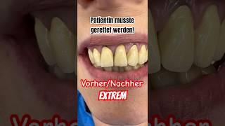 Zahnkronen Vorher/Nachher - #zahnarzt #schönezähne #zahnersatz #zahnkrone