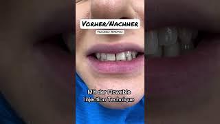 Flowable Injection by Dr. Boeddinghaus #veneers #flowableinjection #schönezähne #zahnarzt