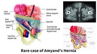 AMYAND'S HERNIA