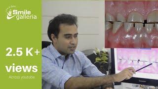 Teeth Wear - Types, causes and treatment options for tooth decay | Dr. Jugal Panchal | Anand