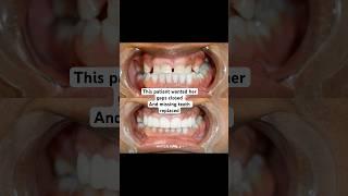 Got missing teeth? Got gaps? Watch this smile transformation ️