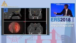 ERS London 2018, H Stammberger, Advances In Fusion