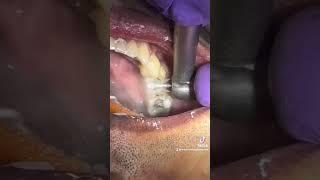 Dental crown preparation.