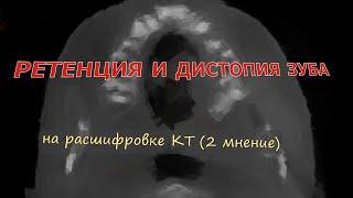 ГРАНУЛЕМЫ на корнях зубов, РЕТЕНЦИЯ и ДИСТОПИЯ ЗУБА на расшифровке КТ зубов (второе мнение)