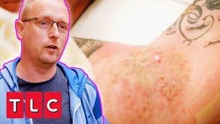Dr. Emma Treats Painful Skin Condition With A Powerful Laser | The Bad Skin Clinic