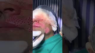 Punch Grafting Surgery in Vitiligo | vitiligo | punch grafting | Skinaa Clinic #shortviral