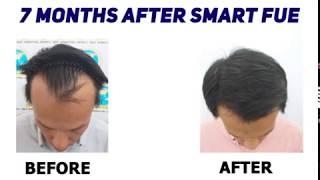 Revitalize Your Look with SMART FUE Hair Restoration | Glojas Aesthetic Clinic