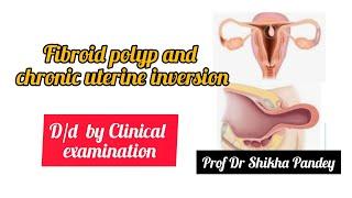 Clinical examination in Gynecology. endometrial polyp,uterine inversion d/d@saisamarthgyneclasses