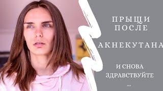 Прыщи после лечения Акнекутаном/Роаккутаном. РЕЦИДИВ