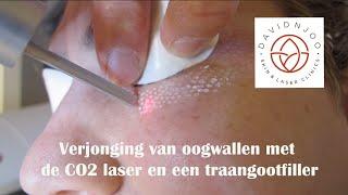 Verjonging van wallen onder de ogen met de CO2 laser en een traangootfiller