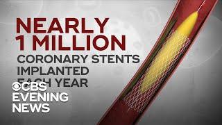 Heart disease trial could reduce the number of patients getting stents