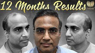 Amazing Transforming Hair Transplant Before and After Results in Grade 6 Baldness (India) | Medlinks