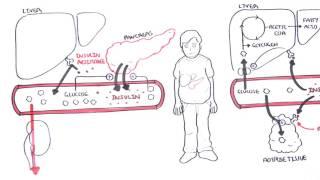 Diabetes Type II Pathophysiology