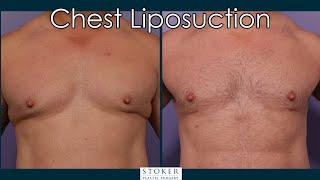 Male Chest Liposuction: Los Angeles Plastic Surgeon Dr. David Stoker Describes Liposuction in Males