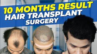 Hair Transplant Time Lapse  |  Step by Step Hair Transplant Surgery Time Lapse