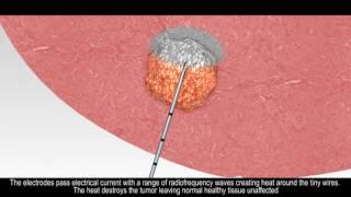 Animation of liver tumor radiofrequency ablation