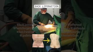 #BackLiposuction #Liposuction  #BodyContour #FatRemoval#Back Sculpting #BackFatRemoval  #Beforeafter