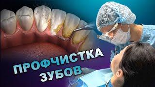 Профессиональная чистка зубов перед фиксацией брекетов #orthodontist #bracket #брекеты