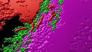 Complexity of tumors revealed in 3D