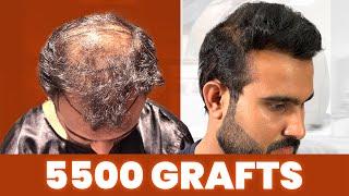 Grade 6 Baldness Hair Transplant Results | Hair Transformation in New Roots