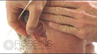 OTOPLASTY EAR SURGERY- Award Winning " Best of Nashville" Plastic Surgeon Dr. Chad Robbins