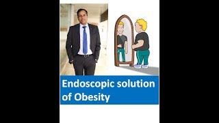 Motape ka ilaj (मोटापे का इलाज ). Endoscopy for weight loss and obesity, Endoscopy se wazan kam.