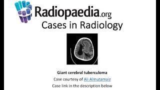 Giant cerebral tuberculoma (Radiopaedia.org) Cases in Radiology