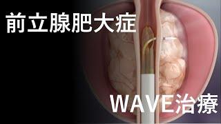 【前立腺肥大症】最新治療！　WAVE治療！！