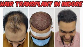 Hair transplant in indore | Best Doctor with Best cost & results | Hair Transplant Clinic