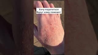 Холодовая аллергия