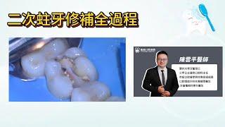 二次蛀牙修補全過程 |蛀牙 |齲齒 |牙齒美容 |牙齒修復 |牙齒修補 |牙齒健康 |口腔健康 |牙齒美白 |珠海牙醫推薦 |齒科推薦