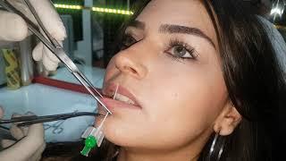 Labret - Dudak - Piercing Deldirme Sonrası İlk Değişim ??