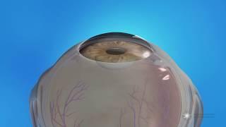 Femtosecond Laser-Assisted Cataract Surgery