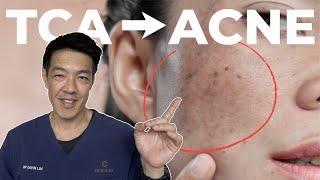 TCA for Ice pick scars | Dr Davin Lim