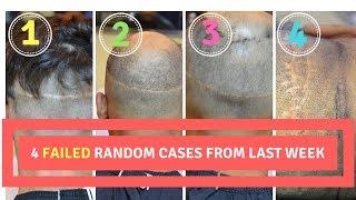 FAILED FUT Hair Transplant Revision with FUE Technique